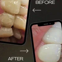 لمینت سرامیکی Emax با شرایط ویژه اقساطی 6 ماهه