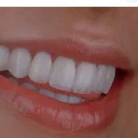 تخفیف ویژه عصب‌کشی ترمیم و کشیدن دندان