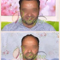 کاشت فوق تخصصی مو‌. ریش  ابرو. لیزرالکس‌مو‌زائد
