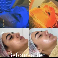 مزوتراپی و فیشال تخصصی پاکسازی صورت