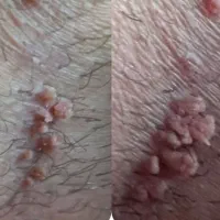 درمان زگیل و تبخال تناسلی کاملاً محرمانه(HPVوHSV)