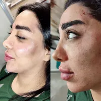 فیلر ، ژل و بوتاکس|خدمات آرایشگری و زیبایی|رباط‌کریم, |دیوار