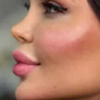 تزریق ژل و بوتاکس ،مزونیدلینگ،خالبرداری،پلکسر