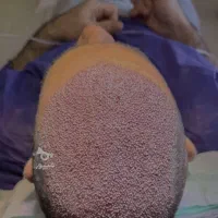 کاشت مو پرتراکم با تضمین کتبی نقد اقساط|خدمات آرایشگری و زیبایی|ساری, |دیوار