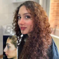 عمل بینی -15م