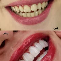کامپوزیت دندان با ضمانت