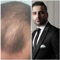 کاشت ابرو و مو سبک شیرازی