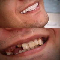 لمینت متحرک دندان