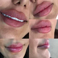 تزریق فیلر و بوتاکس بصورت تخصصی در فولادشهر