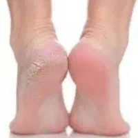 پدیکور و کف سابی پا درمان پینه پا در یک جلسه