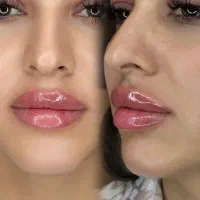 تزریق ژل و بوتاکس