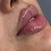 جشنواره تخفیف50%ژل وبوتاکس