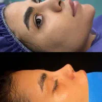 عمل‌ زیبایی‌ و جراحی بینی