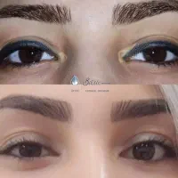 ریمووتتو ابرو چشم لب وانزیم تراپی ابرو انجام میشه