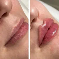 تزریق ژل و بوتاکس،قیمت ویژه،فرم دهی و جوانسازی