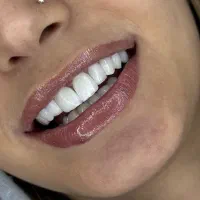 مناسب ترین تعرفه خدمات دندانپزشکی عصب کشی با ضمانت