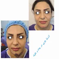 معجزه ای به نام تزریق چربی