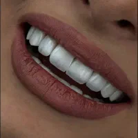 دندان پزشکی / کامپوزیت / کامپوزیت دندان/ ایمپلنت