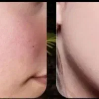 خدافظی با کدری پوست در چند دقیقه