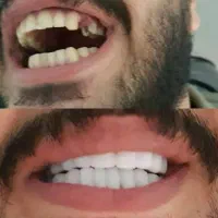 لمینت متحرک sow smile دو فک+خمیر اضافه