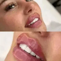 لیزر خانم آقا ژل بوتاکس هایفو لاغری امبدینگ