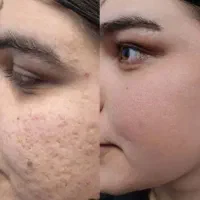 کرم معجزه  بمب کلاژن و روشن کننده قوی