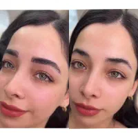 میکروبلیدینگ