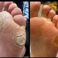 پدیکور تخصصی (  کف سابی پا )