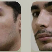 اخرین بازه که ریشات در میاد