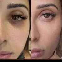 رفع خستگی و تیرگی چشم