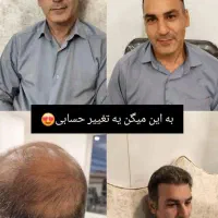 کاشت مو،ابرو،ریش فول تراکم کاملا تضمینی