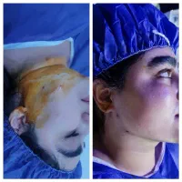 تزریق ژل و چربی بوتاکس و انزیم