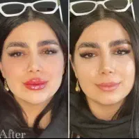 جشنواره روز پدر  ژل لب فیلر چشم بوتاکس‌ مزوژل