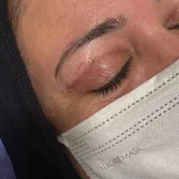 جشنواره بلفاروپلاستی(برداشتن پلک) بخیه لیزری