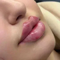 تخفیف با مواد اصل فیلر فقط 650 محدود لب وصورت