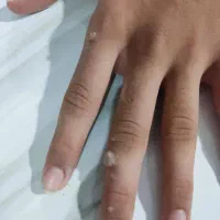 درمان صدرصدی بیماری hpv و hsv