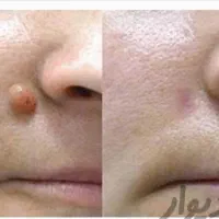 سوراخ کردن گوش وبینی(پیرسینگ)برداشتن خال