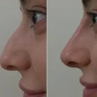 لیفت بینی به صورت موضعی و بدون تزریق و عمل