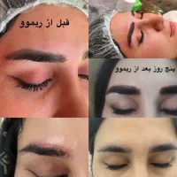 مرکز ریموو  و میکروبلیدینگ با متد اروپایی