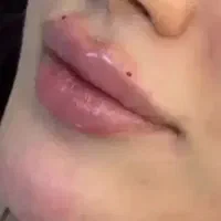ژل وبوتاکس  آنزیم وآموزش