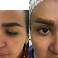 کاشت ابرو با شرایط استثنایی