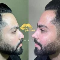 فیلربینی ژل لب روسی متدMمادلینگ خط لبخندگونه شقیقه