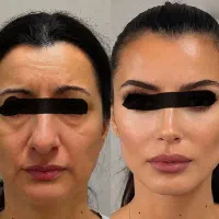 پذیرش بیمار برای جراحی زیبایی صورت