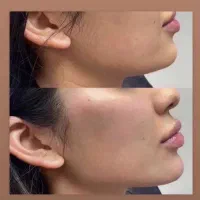 ژل وبوتاکس،پی آر پی،مزو تراپی،پلاسما