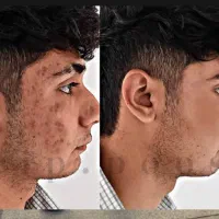 جوشاتو کامل از بین ببر