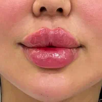ژل لب بوتاکس مزوژل فیلربادی انزیم توسط پزشک فقط۸۵۰