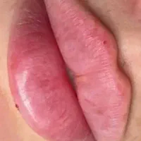 جشنواره ویژه ی فیلر و بوتاکس و فیلر بادی تا۱۳مرداد