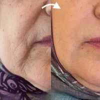 کرم بیوممتیک ۱۲ کاره برای لیفت پوست و جوانسازی