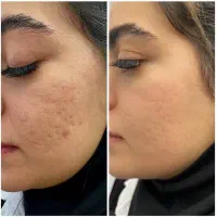 جدیدترین تکنیک خداحافظی با جای جوش تک جلسه در مطب