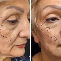 هایفو هفت بعدی لیفت وجوانساز قوی